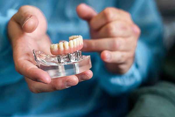 All-on-Four Implants