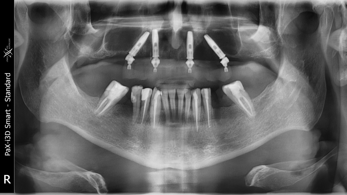 What are the Differences Between Dental Tomography and Panoramic X-ray? What are the Differences Between Dental Tomography and Panoramic X-ray?