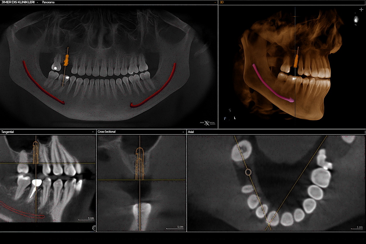 Uses of Dental Tomography Uses of Dental Tomography