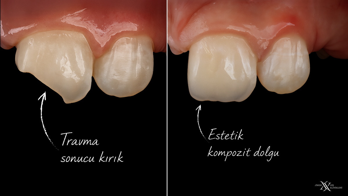 Composite Bonding Applications (Aesthetic Fillings) Composite Bonding Applications (Aesthetic Fillings)