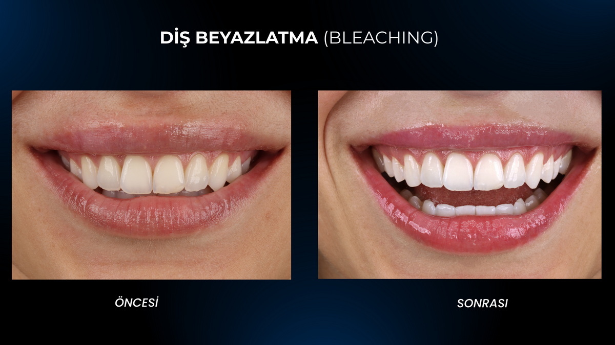 Bursa Teeth Whitening (Dental Bleaching) Bursa Teeth Whitening (Dental Bleaching)