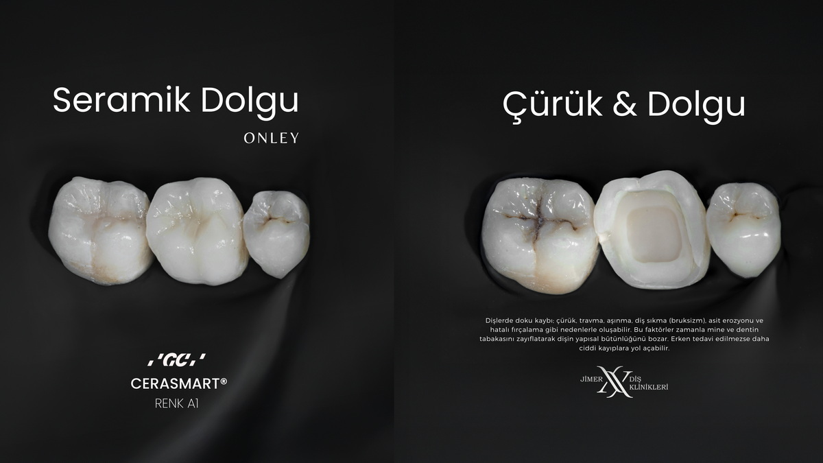 Glass-Ceramic Crowns Glass-Ceramic Crowns