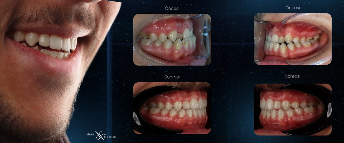 Orthodontic Treatment (Braces or Clear Alignment) Orthodontic Treatment (Braces or Clear Alignment)