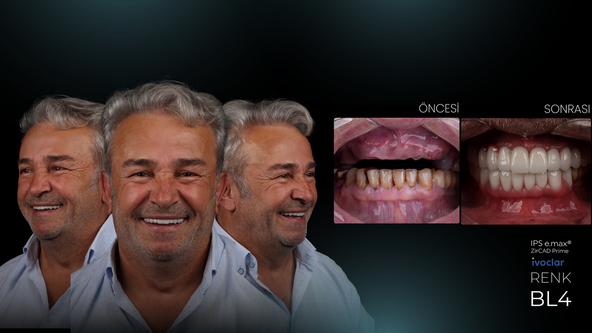 . The Benefits of Cosmetic Dentistry for Patients Personalized Smile Aesthetics and Increased Self-Confidence