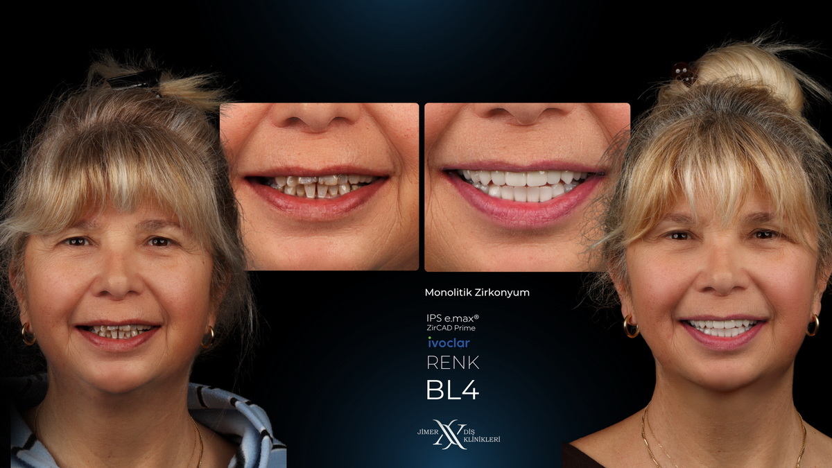 Who is Aesthetic Dentistry Suitable For? Who is Aesthetic Dentistry Suitable For?